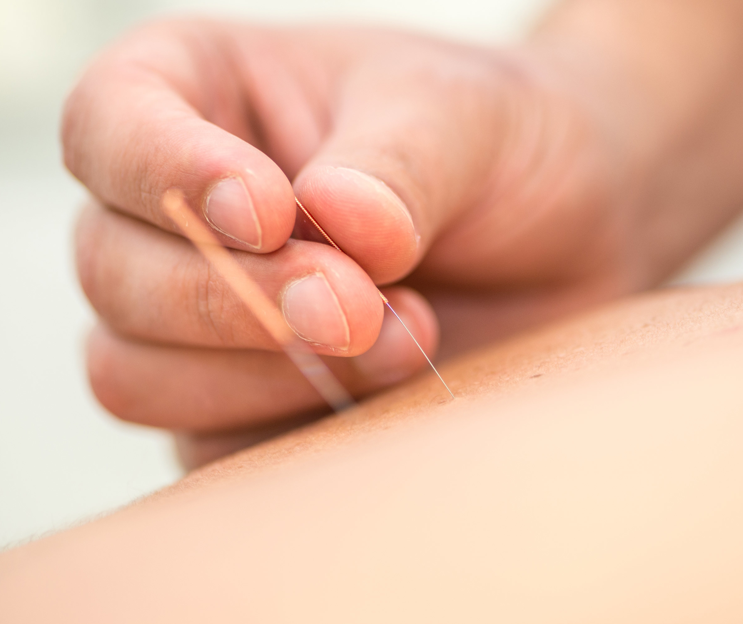 Detail of applying acupuncture needles on a patient's back